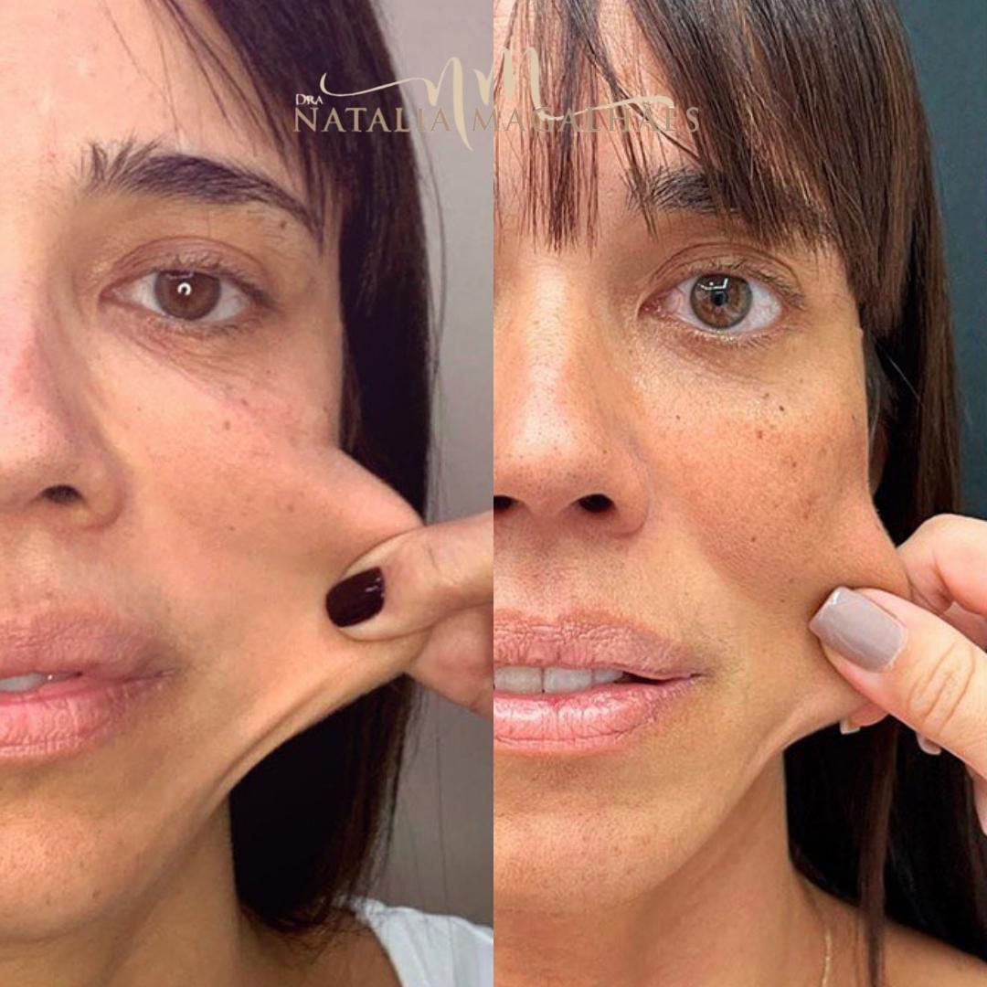 Dra. Natalia Magalhães Bioestimuladores de Colágeno #1.E